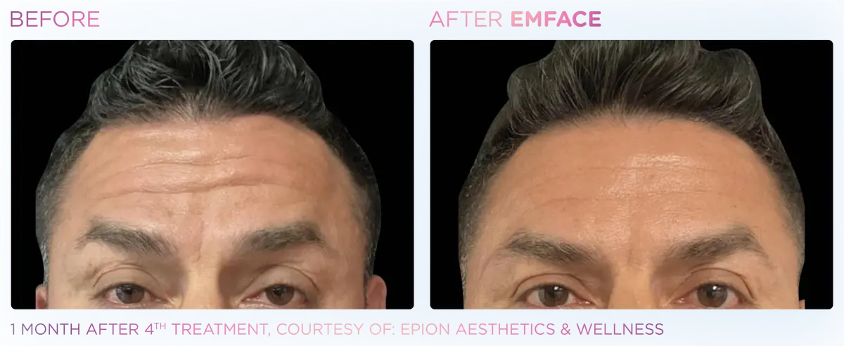 Emface Pic Before And After Forehead Treatment