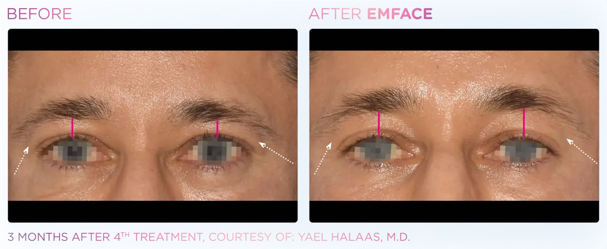 Emface Pic Before And After Forehead Treatment