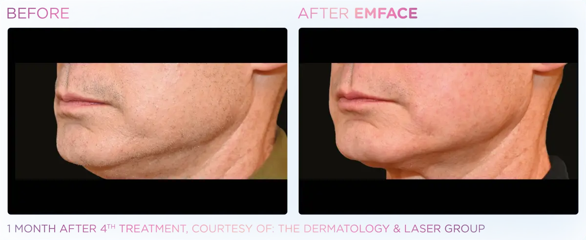 Emface Pic Before And After Jawline Treatment