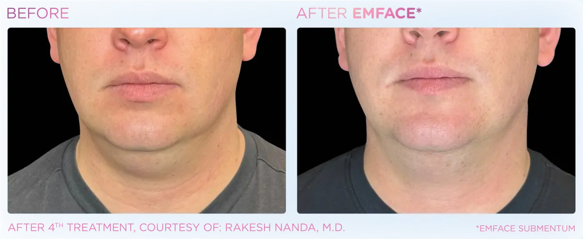 Emface Pic Before And After Submentum Treatment