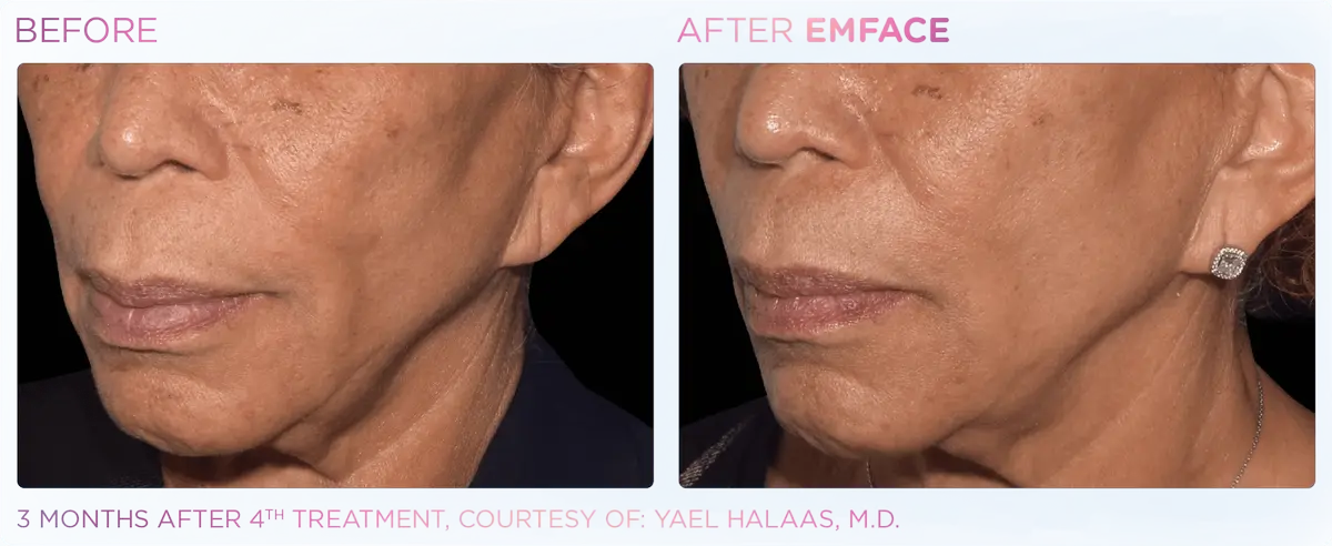 Emface Pic Before And After Cheek Treatment
