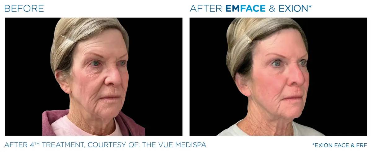 Emface Pic Before And After Face Treatment