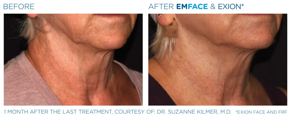 Emface Pic Before And After Neck Treatment
