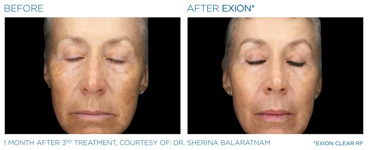 Exion Pic Before And After Face Treatment