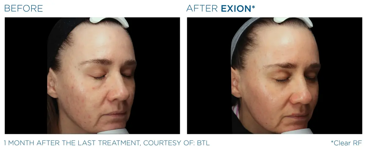 Exion Pic Before And After Face Treatment