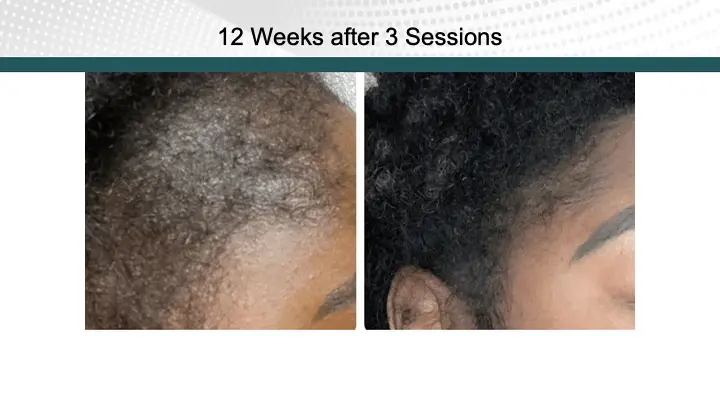 Hair Treatment Result after 3 Sessions