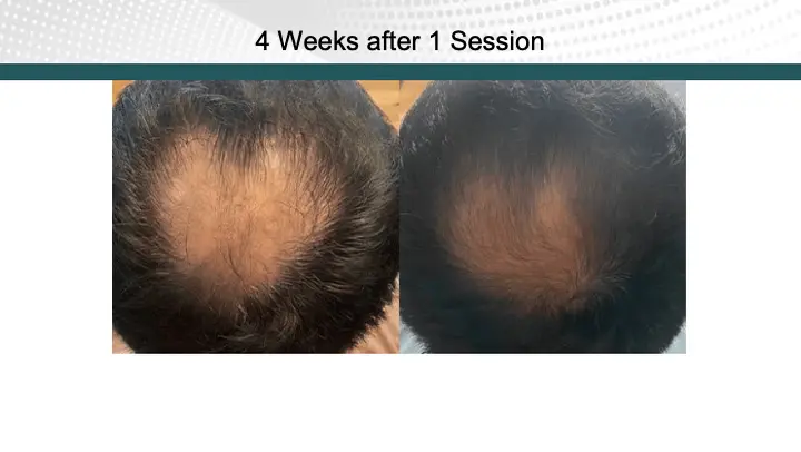 Hair Treatment Result after 1 Session