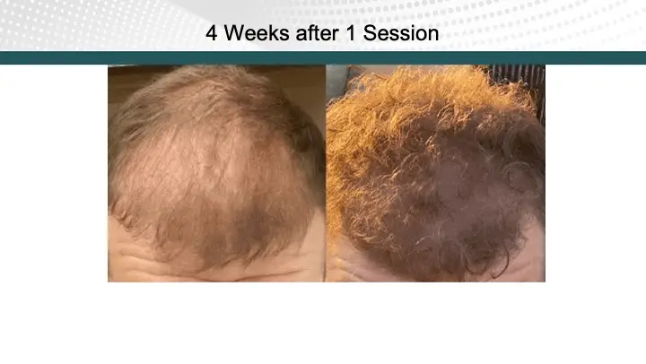 Hair Treatment after 1 Session