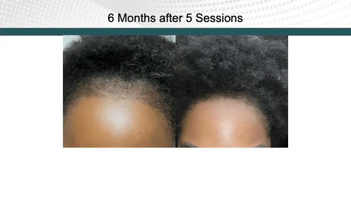 Hair Treatment Result after 5 Sessions