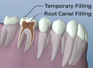 Filling Placed