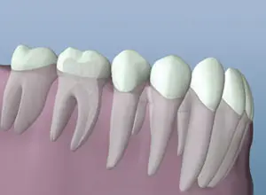 Healed Tooth