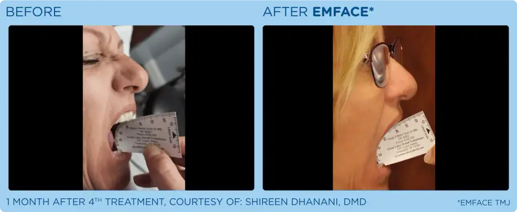 emface-card-female-tmj-before-after