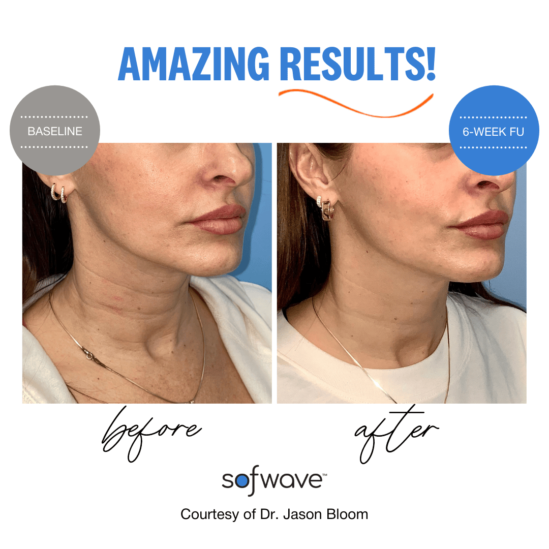 Sofwave before after image