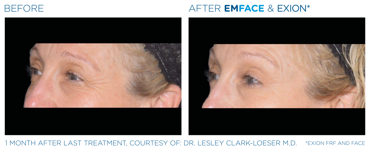 Emface Pic Before And After Eyes Treatment