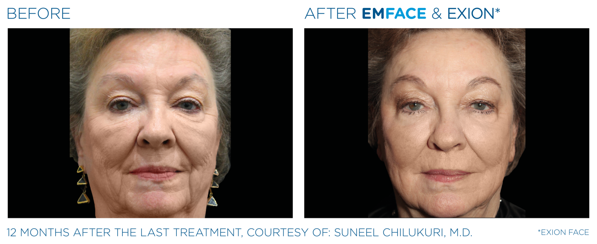 Emface Pic Before And After Face Treatment