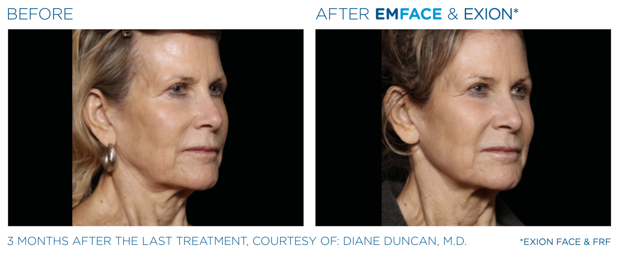 Emface Pic Before And After Face Treatment