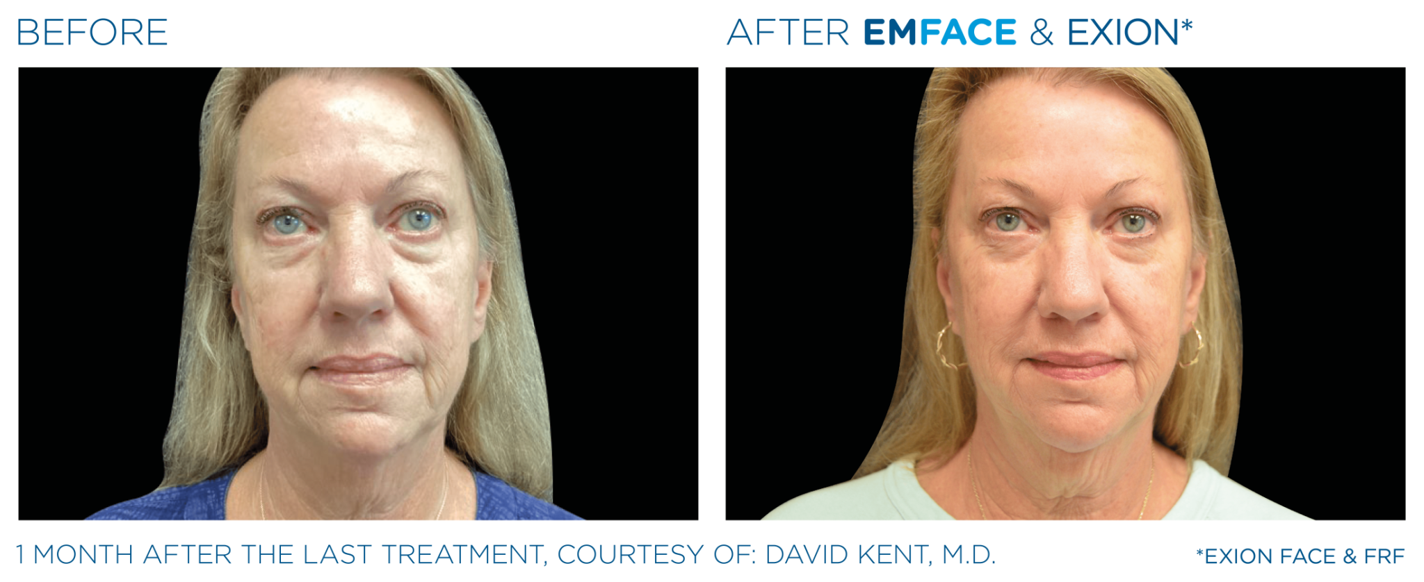 Emface Pic Before And After Face Treatment
