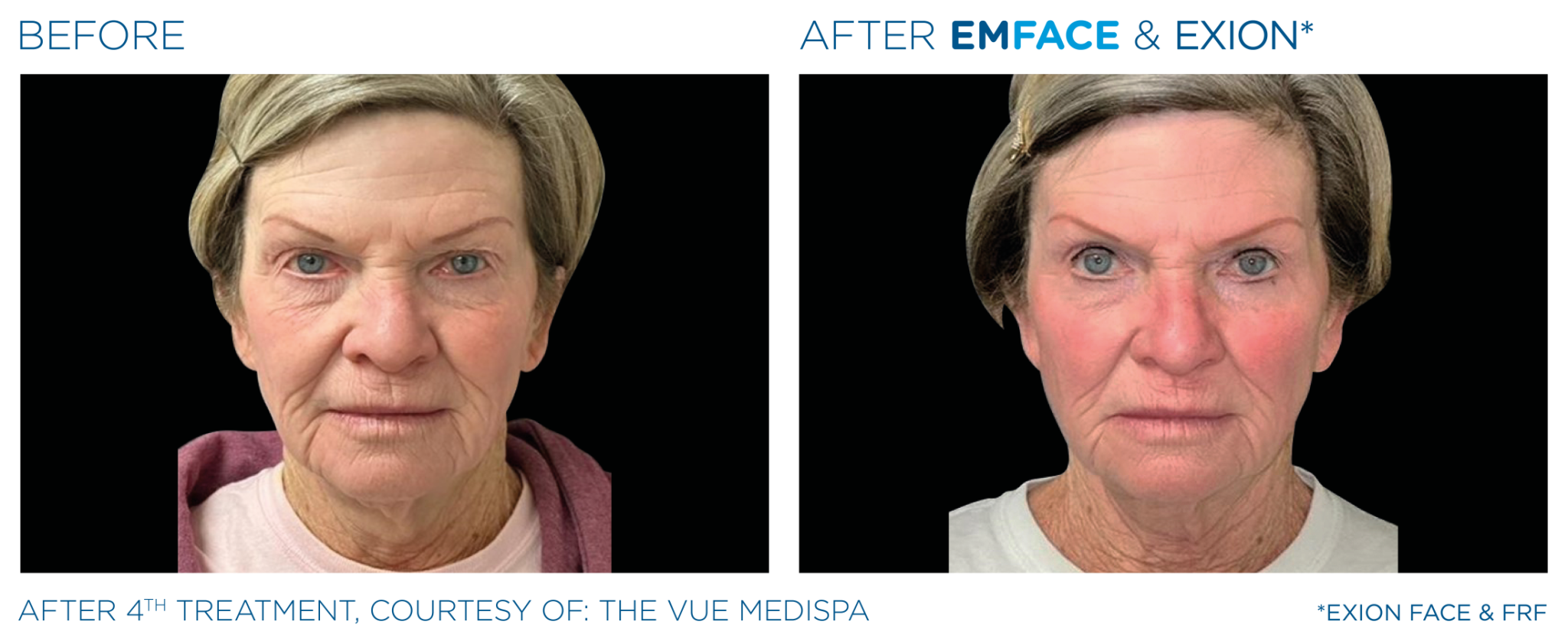 Emface Pic Before And After Face Treatment
