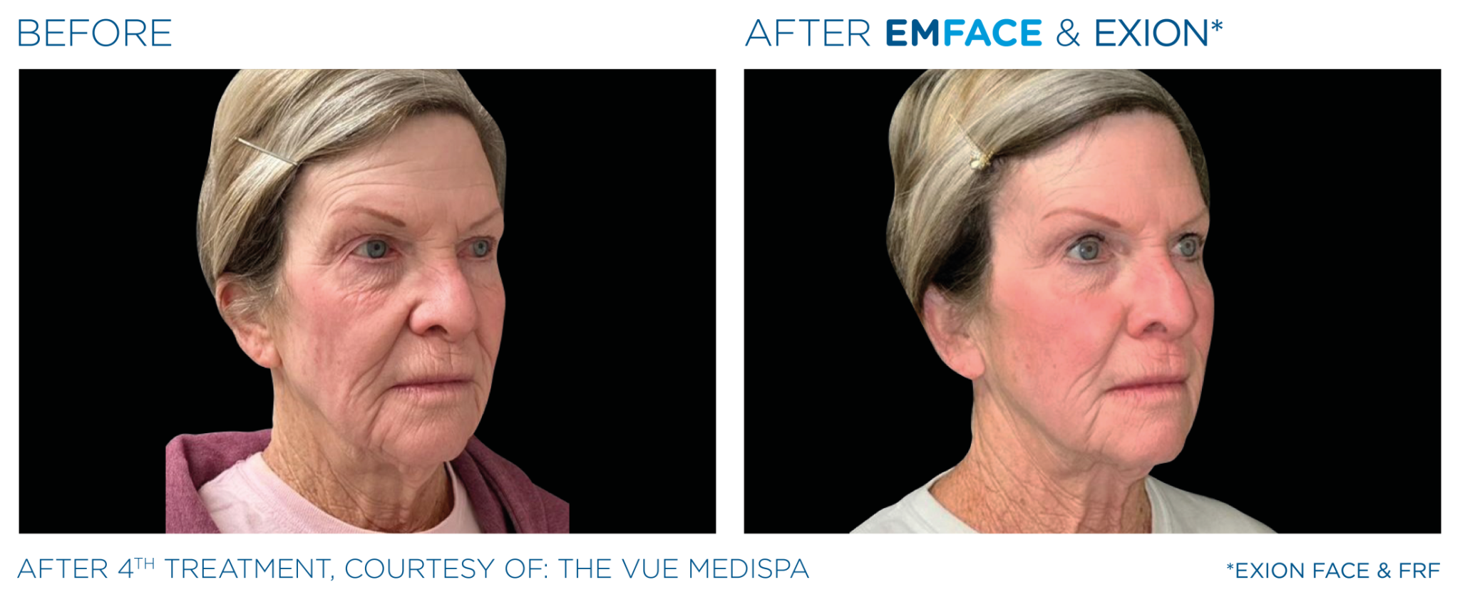 Emface Pic Before And After Face Treatment