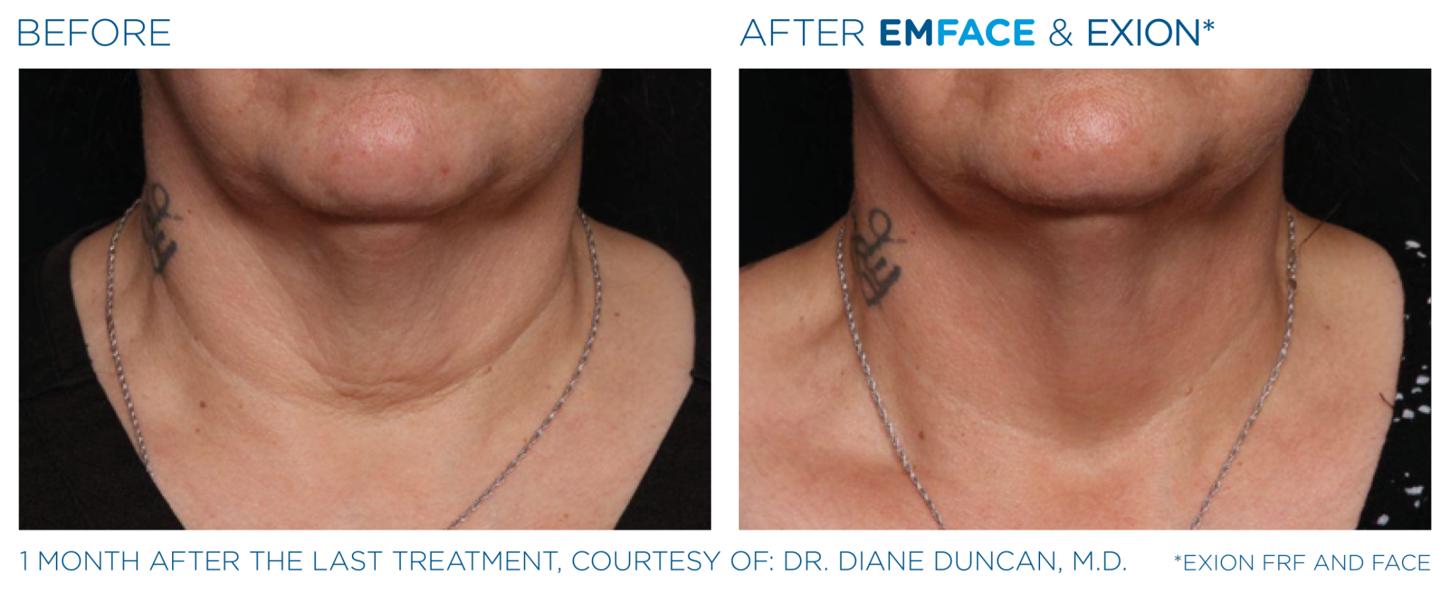 Emface Pic Before And After Face Treatment