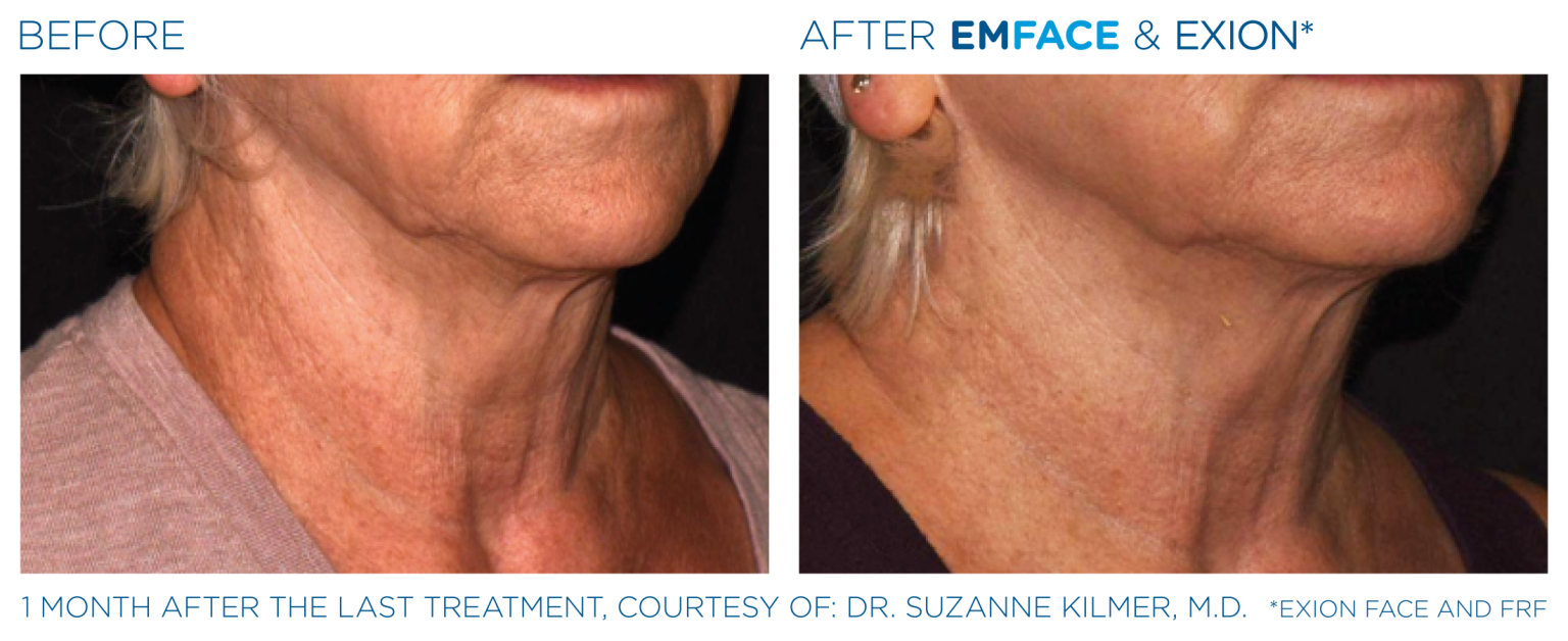 Emface Pic Before And After Neck Treatment