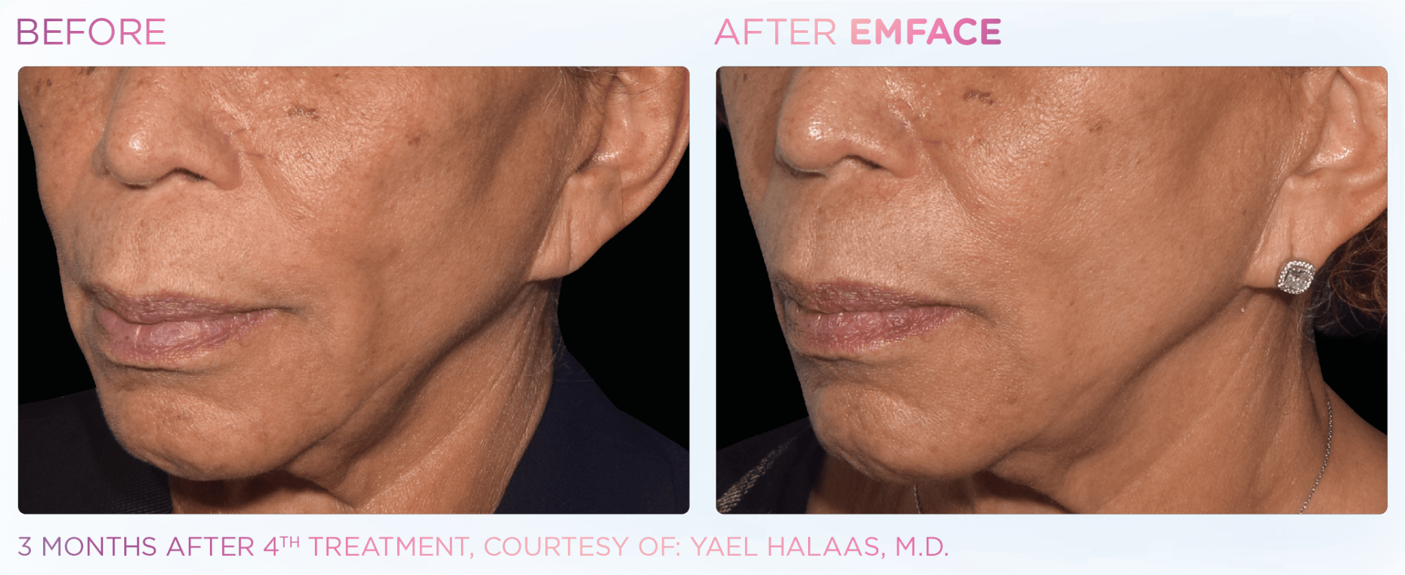 Emface Pic Before And After Cheek Treatment