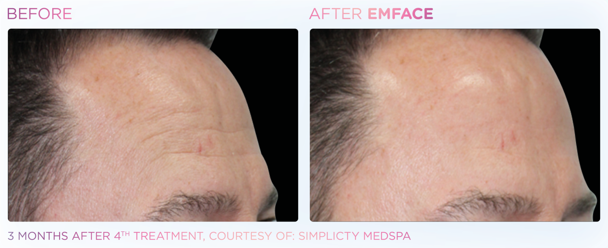 Emface Pic Before And After Forehead Treatment
