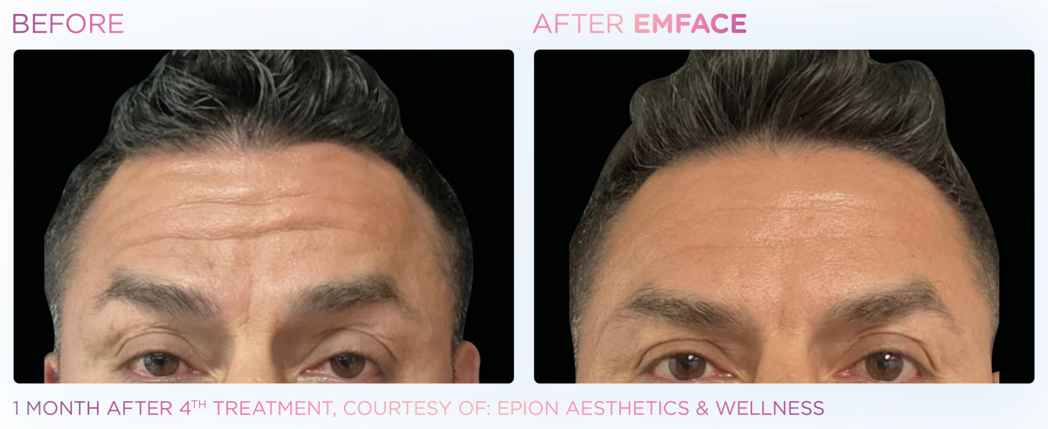Emface Pic Before And After Forehead Treatment