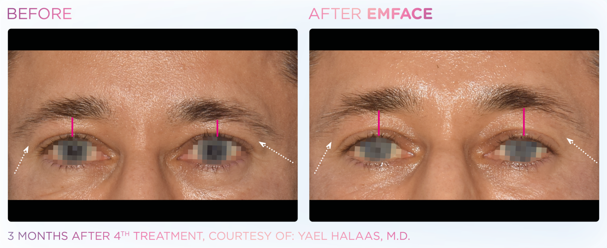 Emface Pic Before And After Forehead Treatment