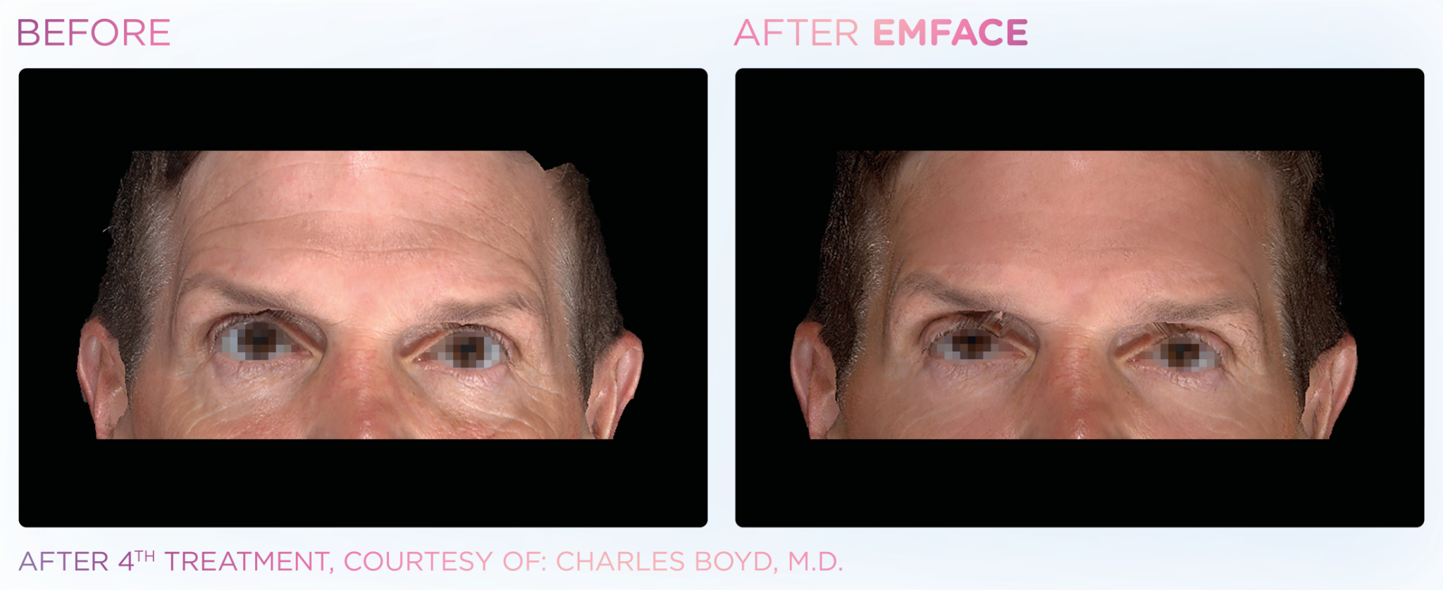 Emface Pic Before And After Forehead Treatment