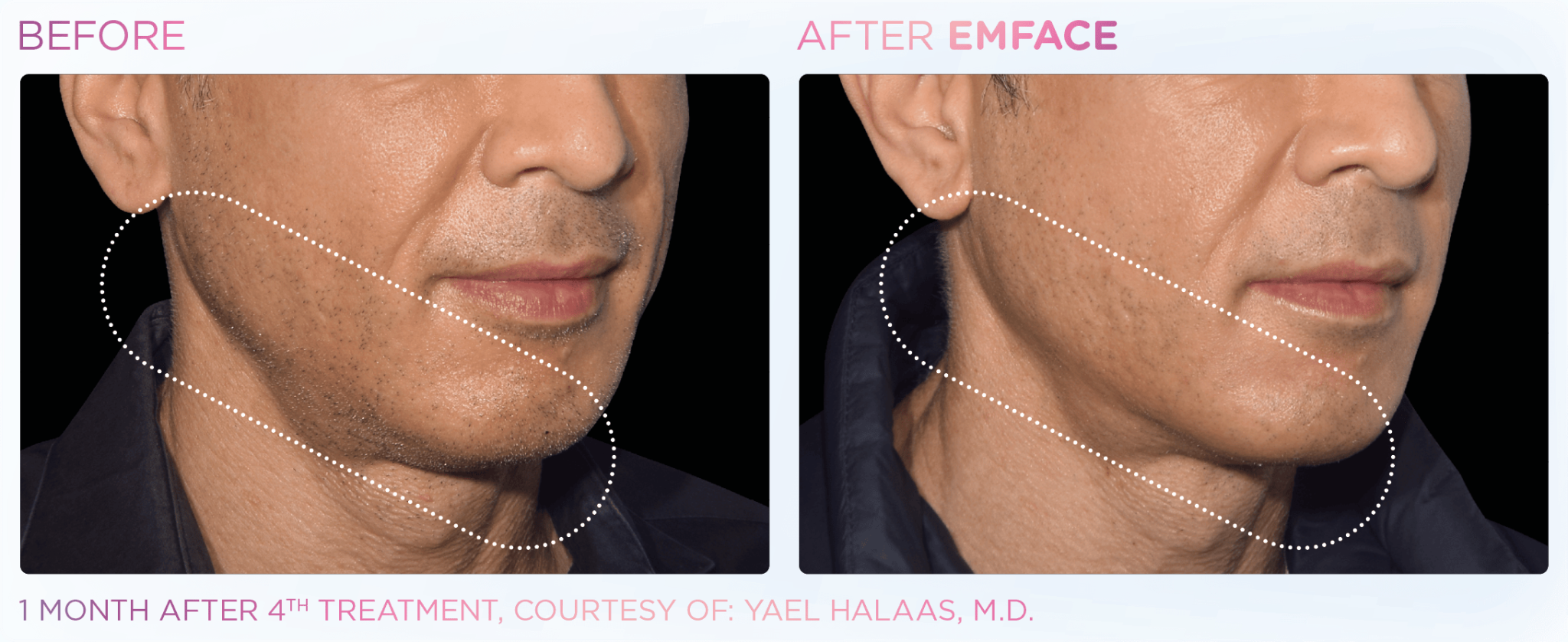 Emface Pic Before And After Jawline Treatment
