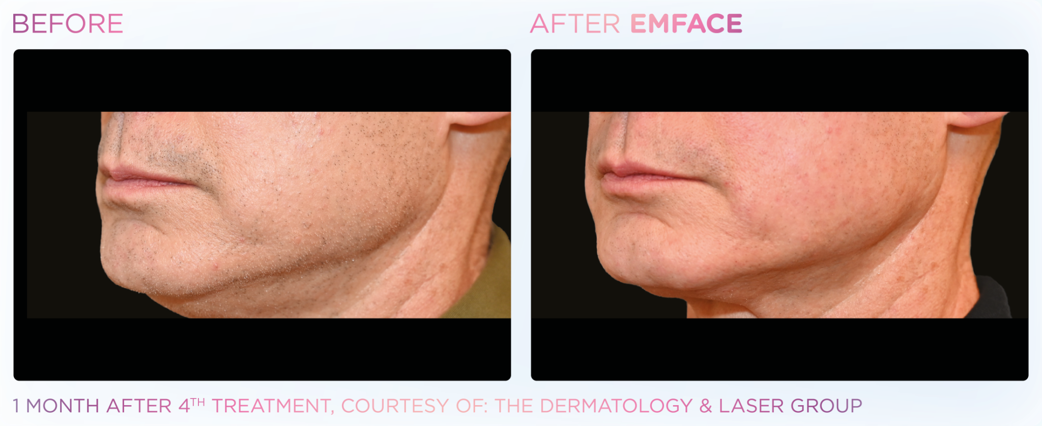 Emface Pic Before And After Jawline Treatment