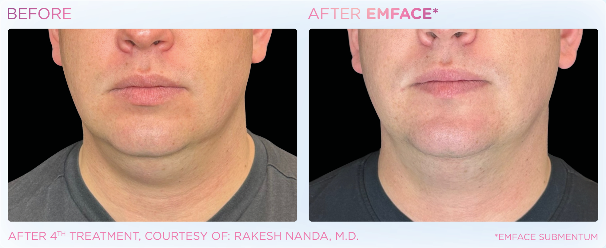Emface Pic Before And After Submentum Treatment