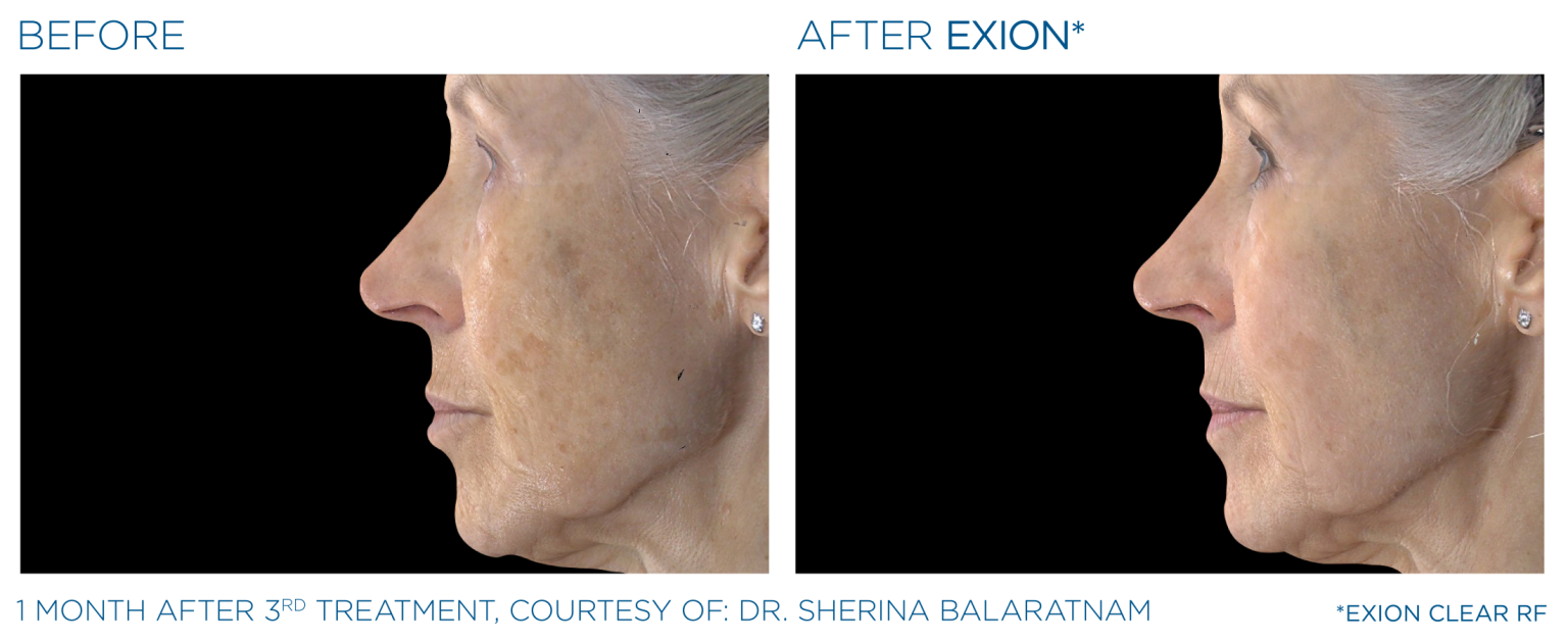 Exion Pic Before And After Cheek Treatment