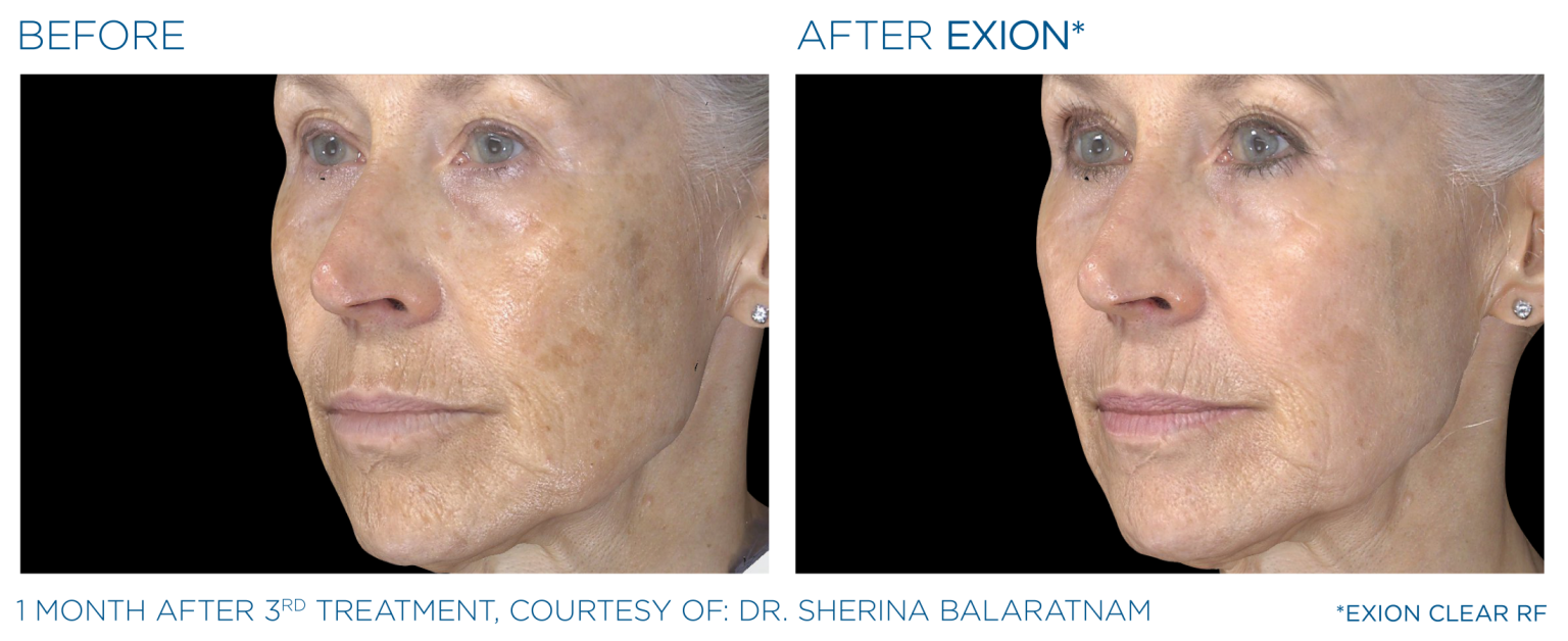 Exion Pic Before And After Treatment