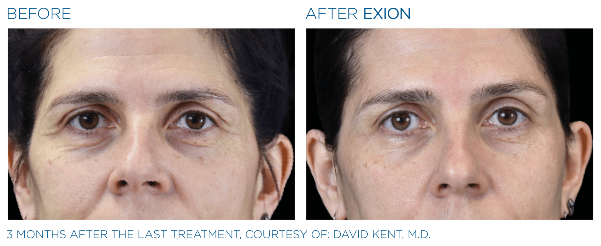 Exion Pic Before And After Eyes Treatment