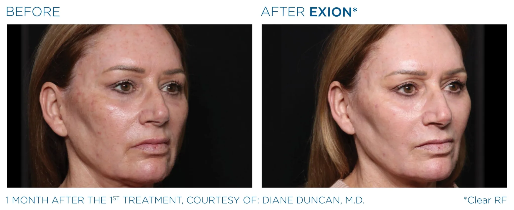 Exion Pic Before And After Face Treatment