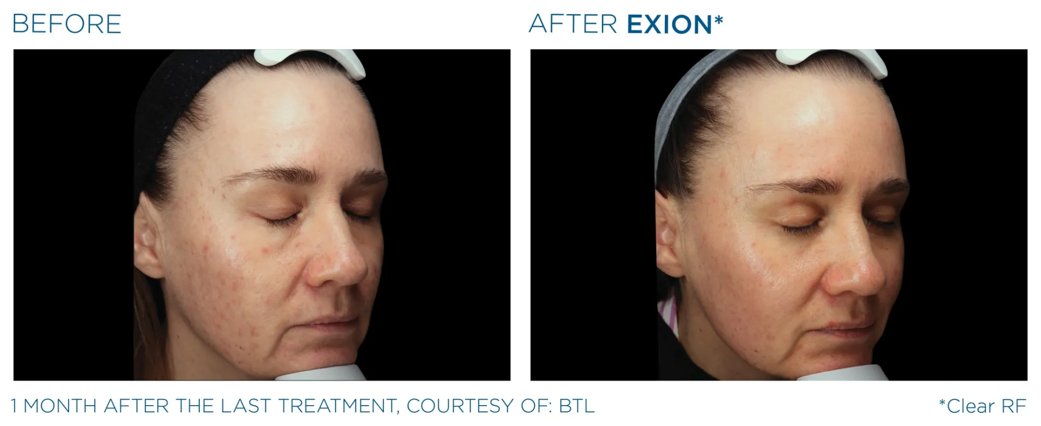 Exion Pic Before And After Face Treatment