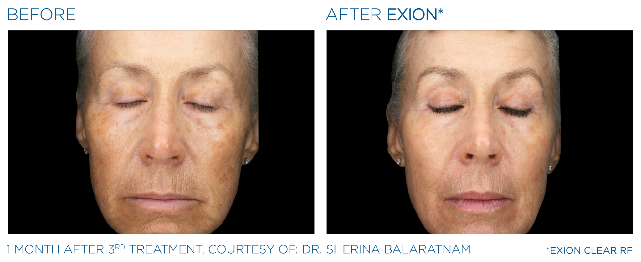 Exion Pic Before And After Face Treatment