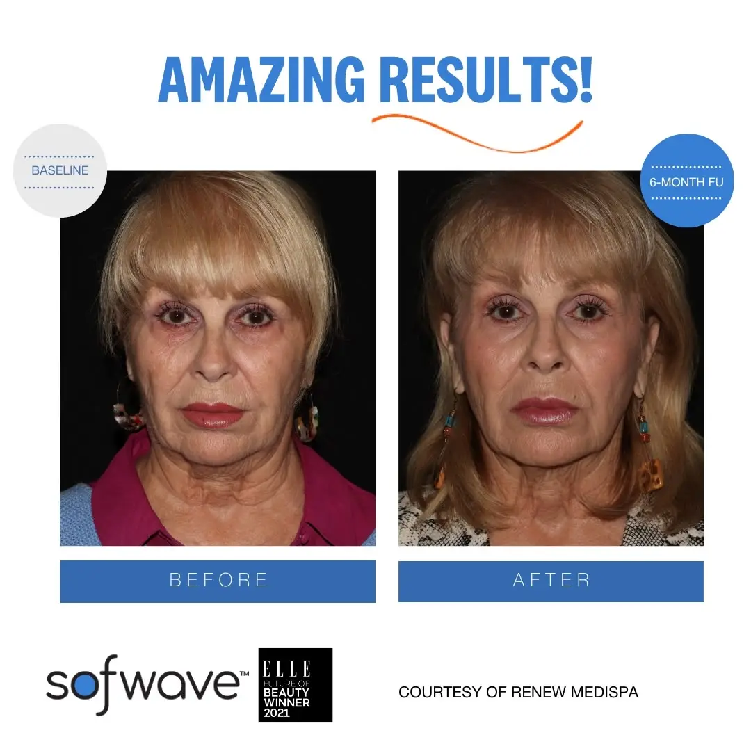 Sofwave before after image
