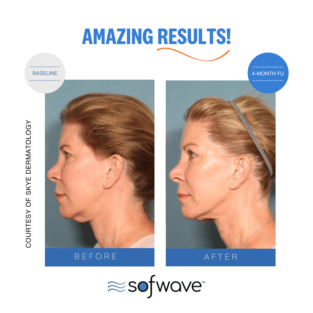Sofwave before after image