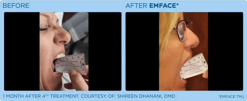 emface-card-female-tmj-before-after