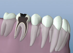 Root Canal Therapy Cleaned Canals Representation