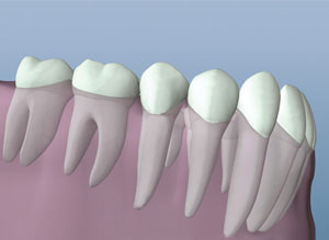 Root Canal Therapy Healthy Tool Example