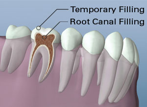 Root Canal Therapy Root Canal Filling Placed Illustration