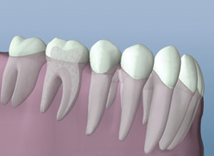 Root Canal Therapy Tooth Healed By Root Canal Therapy