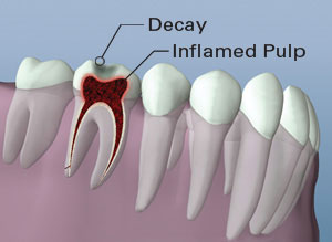 Root Canal Therapy Tooth Inflammation Visual
