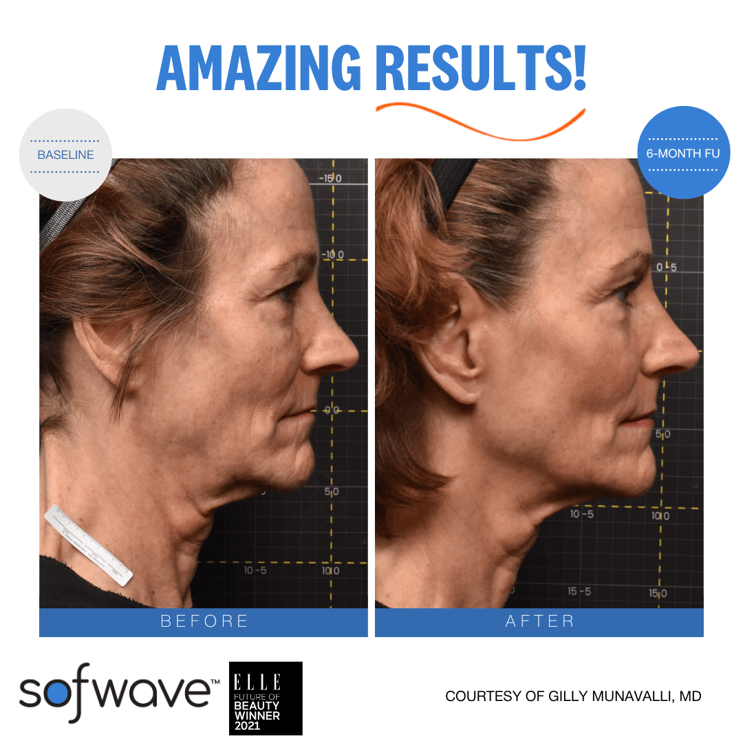 Sofwave before after image